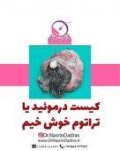 کیست درموئید در مو یکی از انواع کیست های تخمدانی است